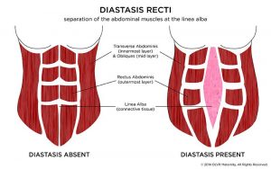 Rectus Diastasis - AKA Abdominal Muscle Separation - ALCHEMY IN MOTION