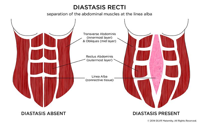 Rectus Diastasis AKA Abdominal Muscle Separation ALCHEMY IN MOTION