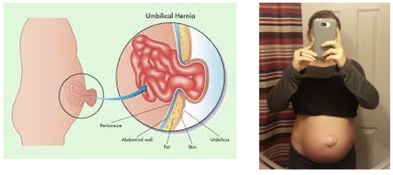 Umbilical Hernia