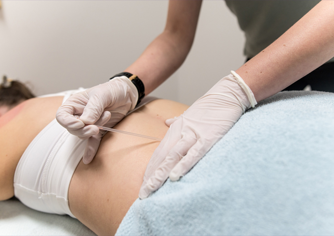 Dry Needling